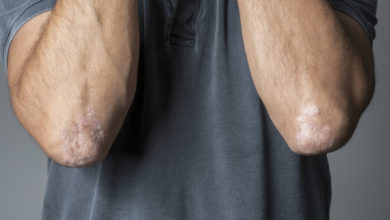 5 diferencias entre la psoriasis y la dermatitis atópica