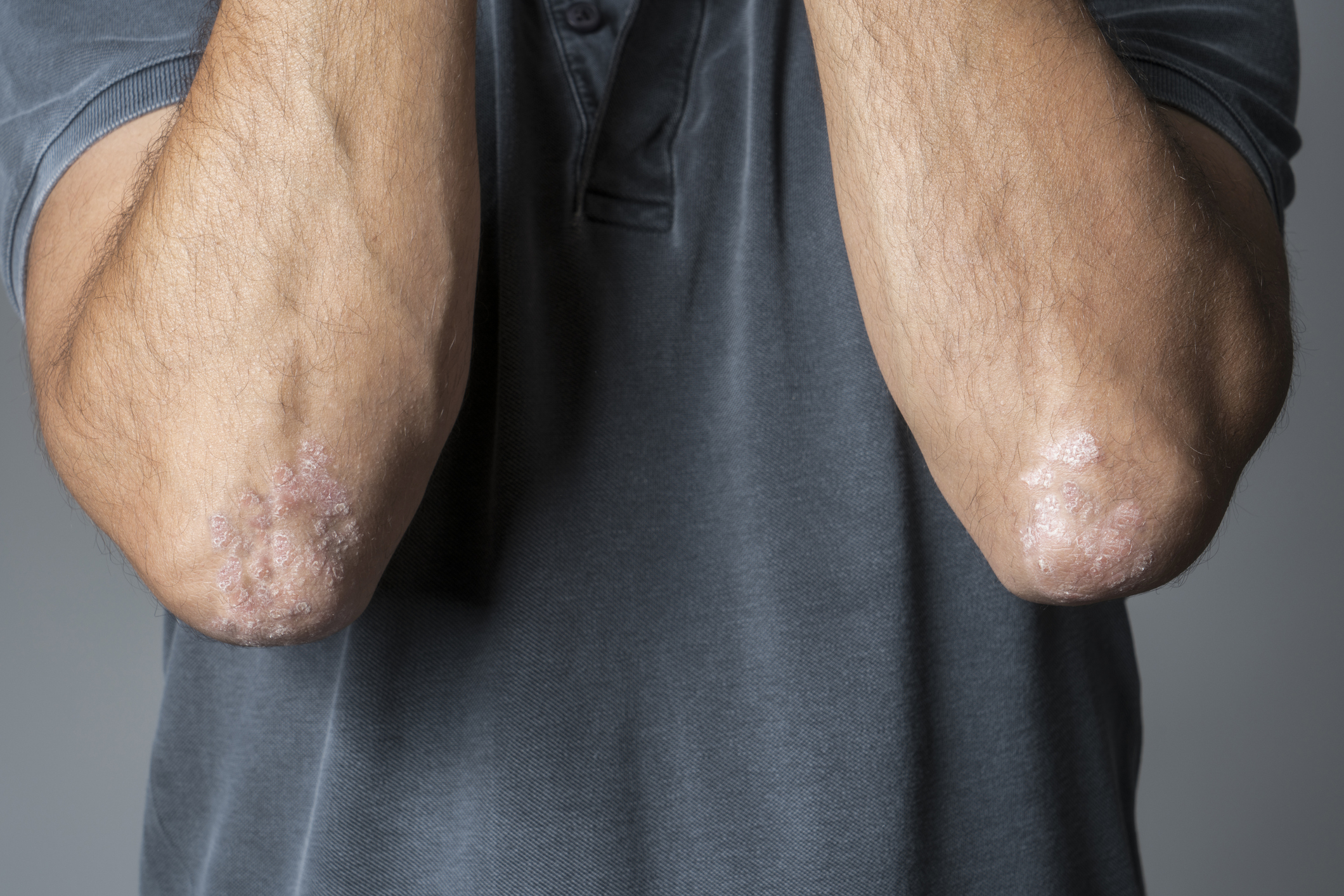 5 diferencias entre la psoriasis y la dermatitis atópica