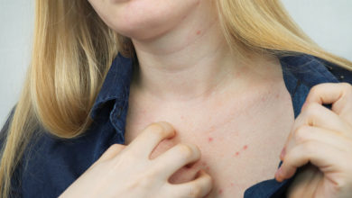 Dermatitis atópica en adultos