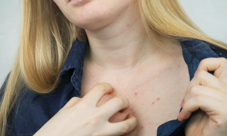 Dermatitis atópica en adultos