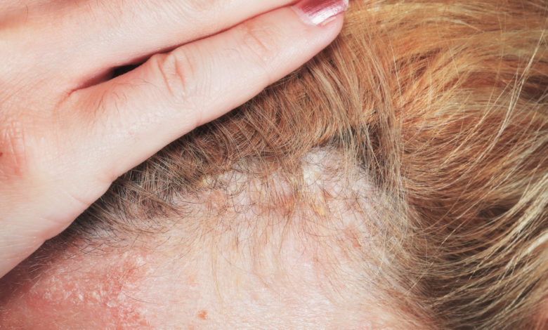 Síntomas principales y tratamientos de la psoriasis