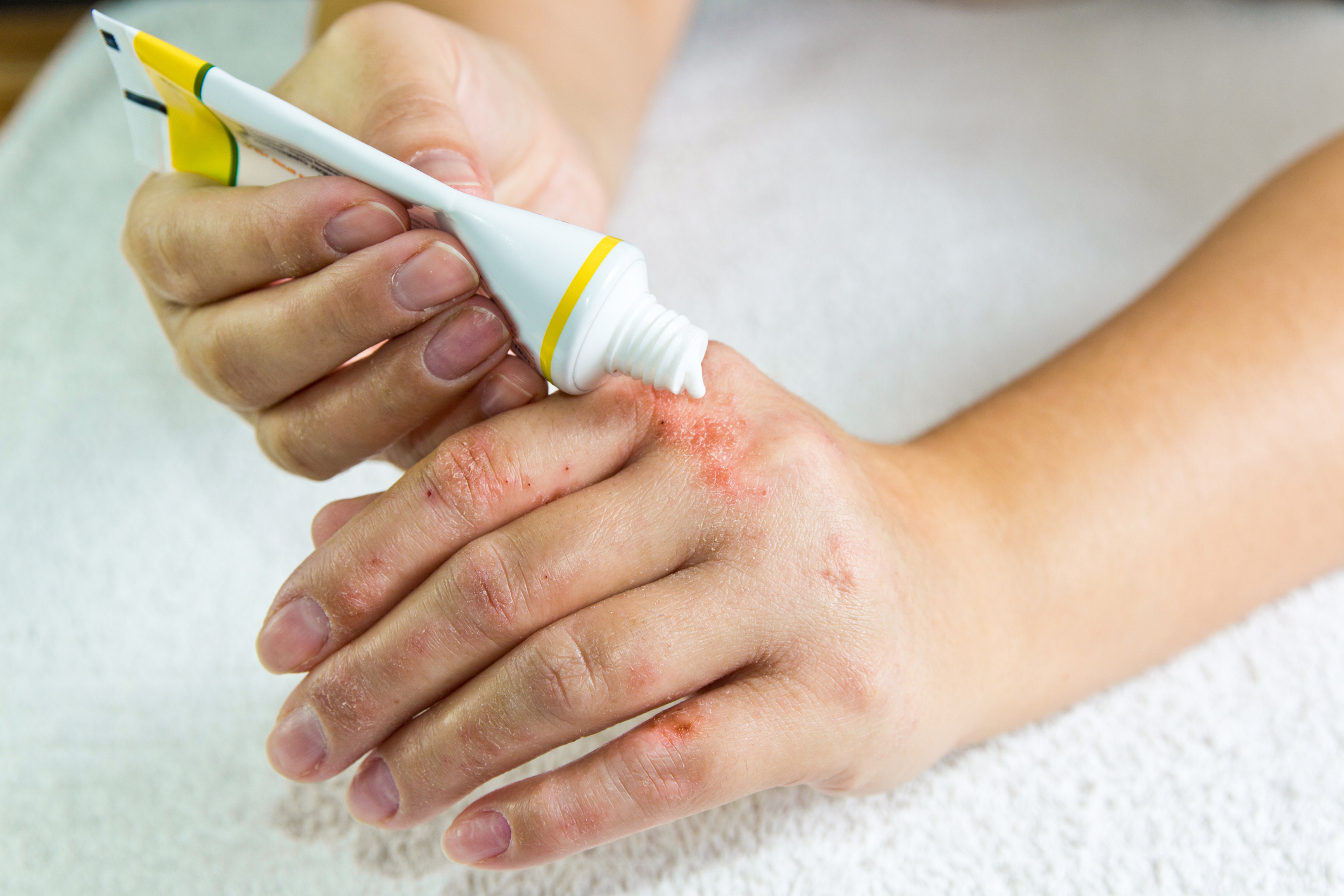 Conoce todos estos tratamientos para el control de la psoriasis