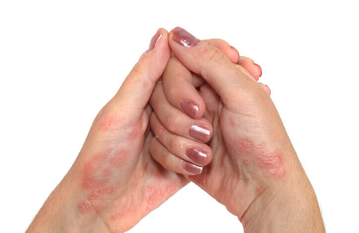 Causas y síntomas de la artritis psoriásica