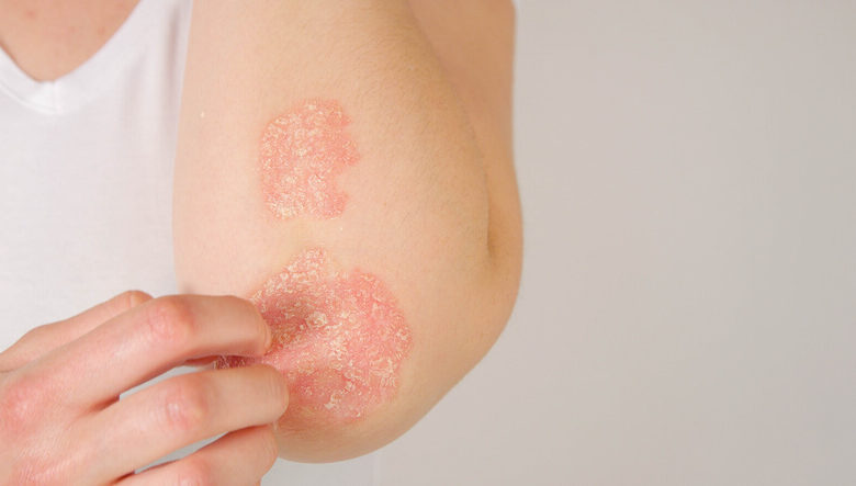 Conoce los diferentes tipos de psoriasis