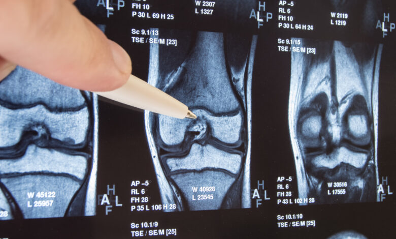 ¿Qué diferencia la artritis reumatoide de la osteoartritis?