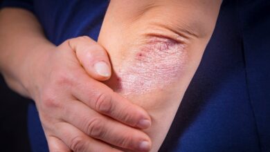 Aproximadamente entre el 7% y 42% de los pacientes con lesiones de psoriasis en la piel padecen artritis psoriásica