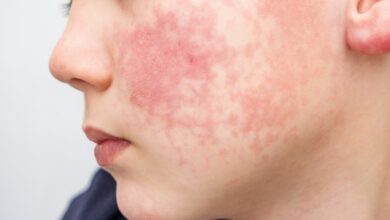 Dermatitis atópica: todo lo que debes saber