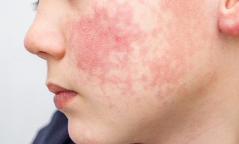 Dermatitis atópica: todo lo que debes saber