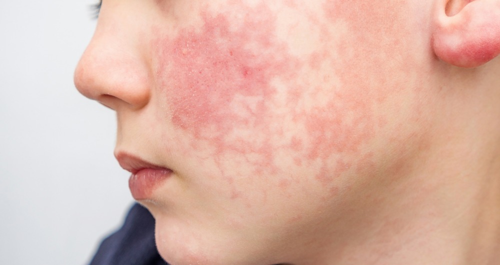 Dermatitis At Pica Todo Lo Que Debes Saber Behealth