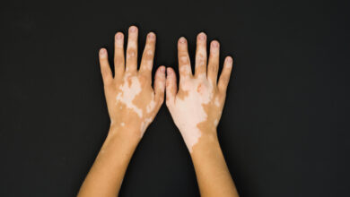 Desarrollan en Cuba nuevos productos a partir de la placenta para tratar el vitiligo