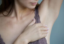 Todo sobre la hidradenitis supurativa