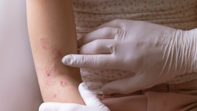 Doctor apuntando a los signos de dermatitis atópica en el brazo de una joven