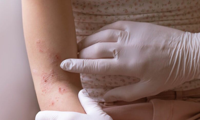Doctor apuntando a los signos de dermatitis atópica en el brazo de una joven