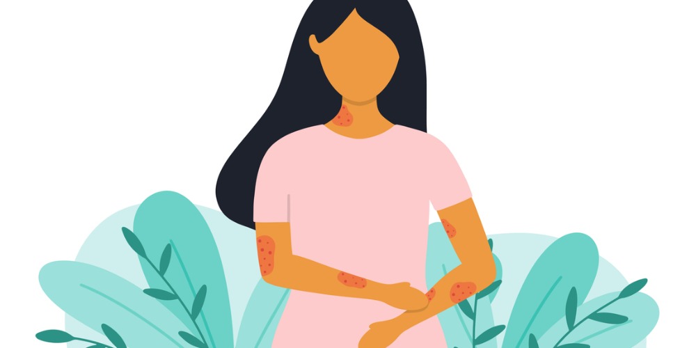 Factores Dermatitis Atopica