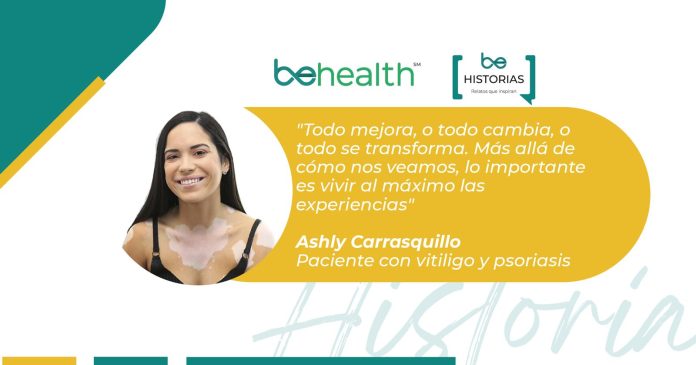 Ashly Carrasquillo - Vitiligo