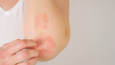 Dermatitis seborreica