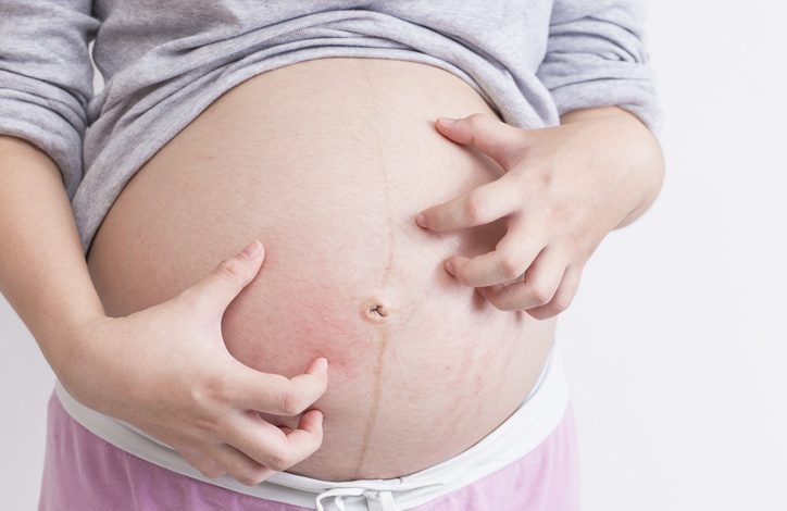 dermatitis atópica en el embarazo