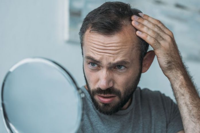 Existen diferentes tipos de alopecia y pueden afectar a hombres y mujeres por igual