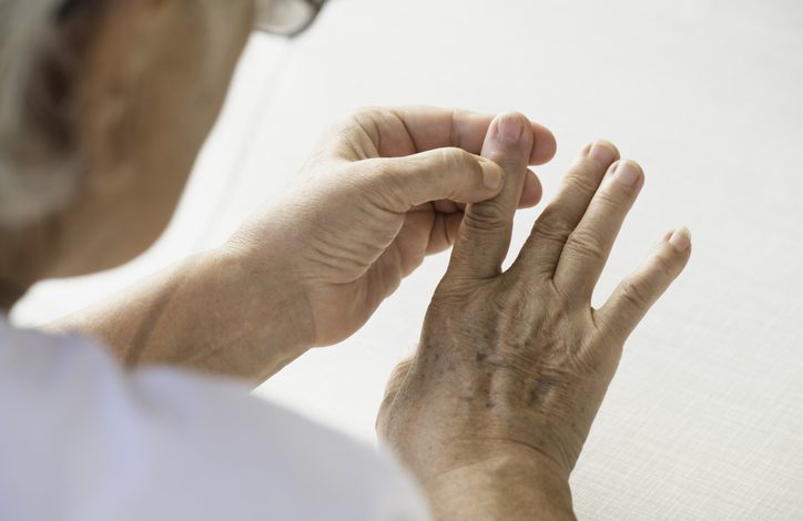 La artritis reumatoide afecta el revestimiento de las articulaciones y causa una inflamación dolorosa.
