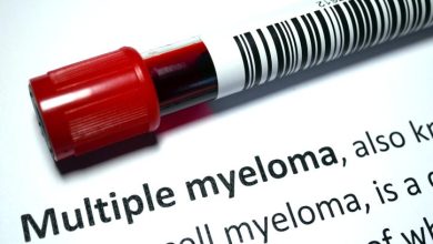 Las personas con amiloidosis combinada con mieloma múltiple tienen una expectativa de vida más corta en general.