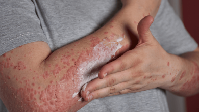 Con grupos de apoyo buscan hacerle frente a la Psoriasis