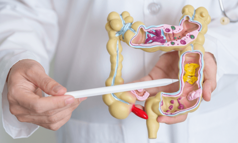 Etapas y evolución de la enfermedad de Crohn