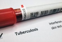 Tuberculosis, una infección en alarma