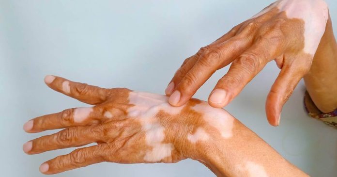 El vitíligo es una enfermedad crónica de la piel, en la que los melanocitos, células implicadas en la producción de melanina.