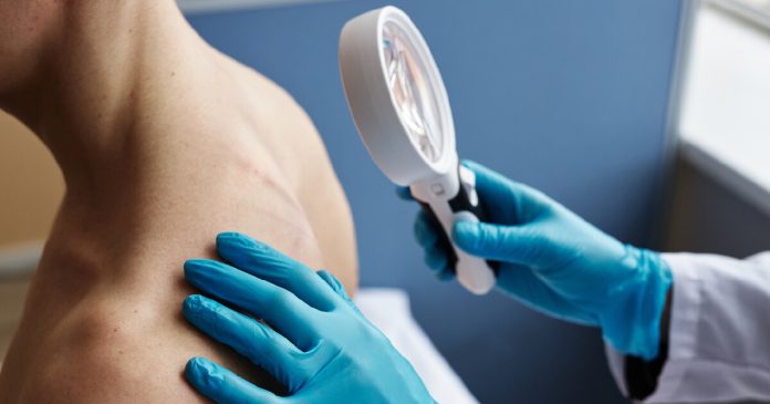 Psoriasis
