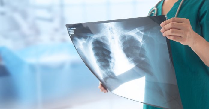 Aumento de casos de tuberculosis