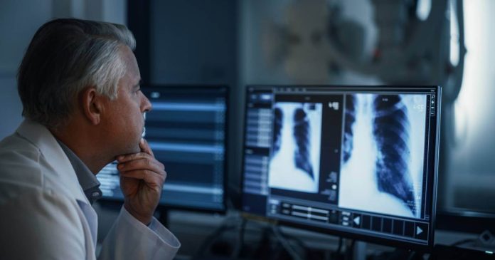 La NIH dice que la capacidad pulmonar total (TLC) como el volumen de aire en los pulmones en el máximo esfuerzo de inspiración.