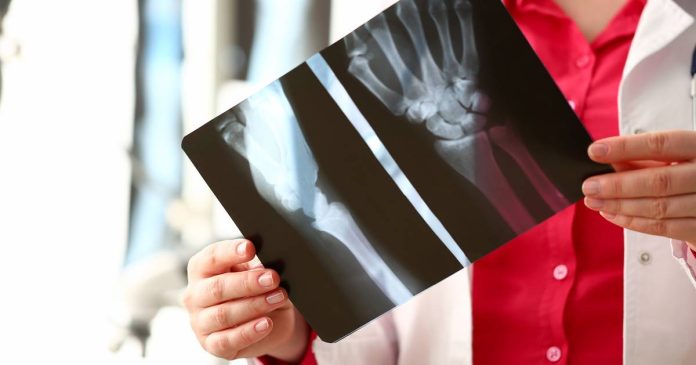 Crean pistola 3D para fracturas óseas
