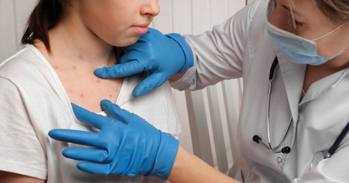 Niños con artritis psoriásica: mantener un peso saludable puede aliviar los síntomas