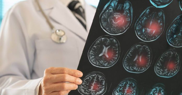 La enfermedad de Huntington es un trastorno hereditario que hace que las células nerviosas del cerebro se desintegran y mueren gradualmente.
