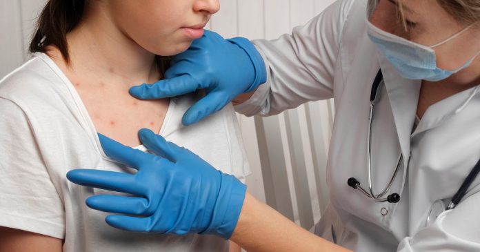 Un aviso sanitario encendió las alarmas en Arizona luego de que funcionarios locales confirmaran posibles exposiciones al sarampión
