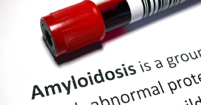 La amiloidosis es una enfermedad poco frecuente heterogénea que resulta del depósito de agregados tóxicos insolubles de proteínas fibrilares.