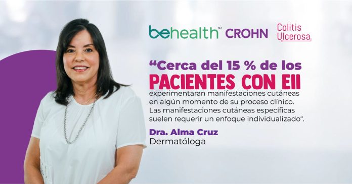 Las EII son una afección crónica que es caracterizada por episodios recurrentes e impredecibles de inflamación gastrointestinal.
