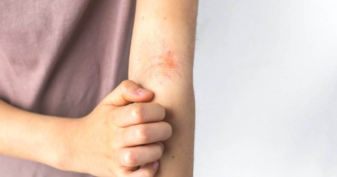 Las personas que padecen de dermatitis atópica, el estrés puede ser un desencadenante para agravar los brotes de estas condiciones.