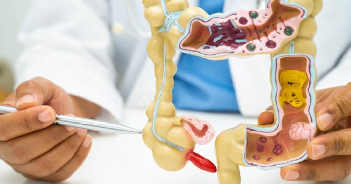 EII y cáncer de colon