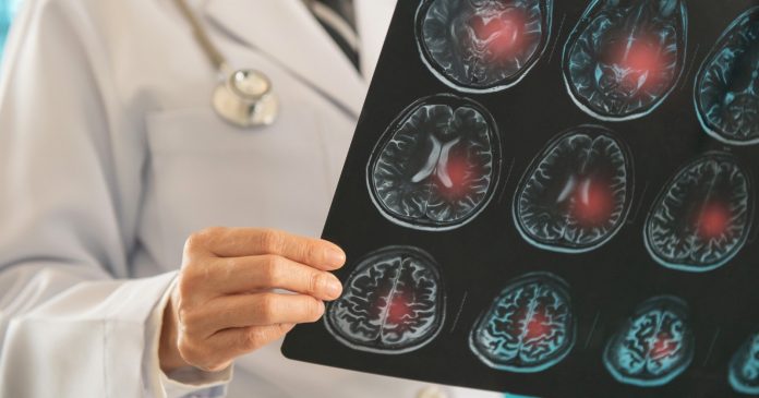 Las mujeres enfrentan un mayor riesgo de sufrir un ataque o derrame cerebral