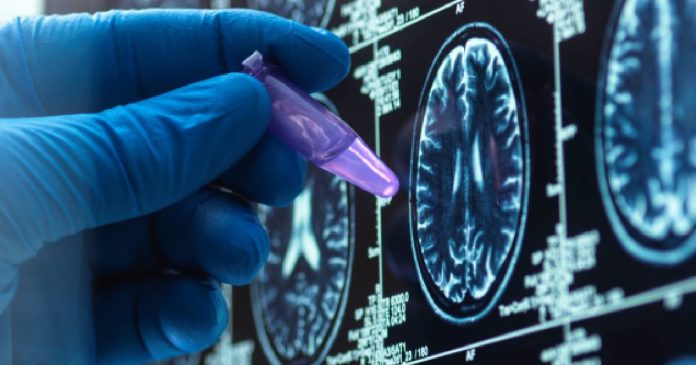 Avances en el tratamiento de la epilepsia