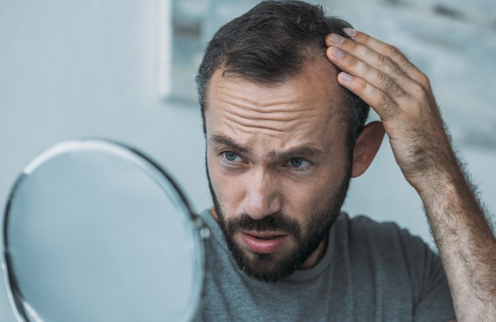 Alopecia es un término genérico que engloba las afecciones caracterizadas por la caída del cabello.