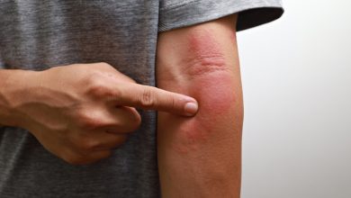 La psoriasis es una enfermedad crónica y autoinmunitaria que afecta a más de 125 millones de personas en todo el mundo, y en Puerto Rico, aproximadamente el 2% de la población la padece.